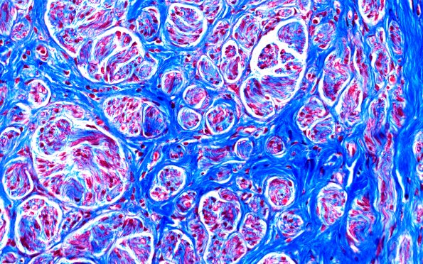 2D2 Neuroma (Case 2) Tri 40X