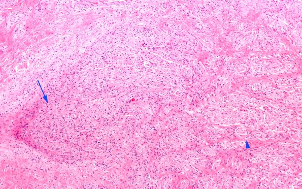 3A1 Neuroma (Case 3) H&E 10X 4 copy