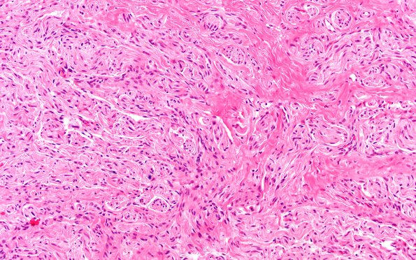 3A2 Neuroma (Case 3) H&E 20X