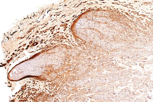 3B1 Neuroma (Case 3) Coll IV 4X