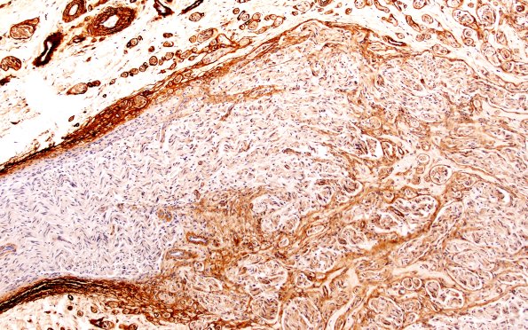 3B2 Neuroma (Case 3) Coll IV 10X