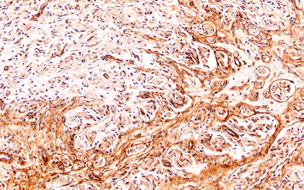 3B3 Neuroma (Case 3) Coll IV 20X