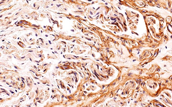 3B4 Neuroma (Case 3) Coll IV 40X