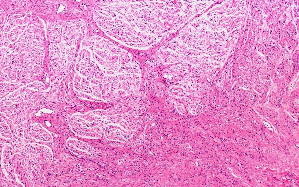 4A1 Neuroma, traumatic (Case 4) H&E 10X 1