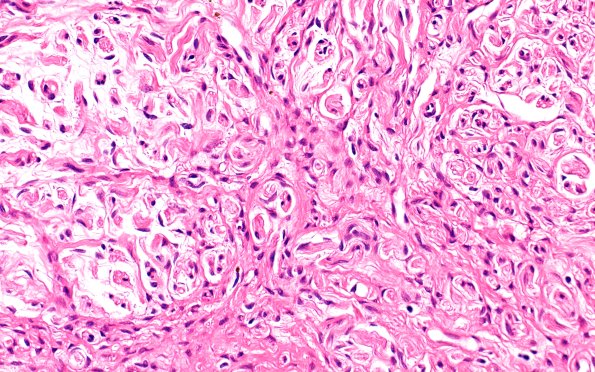 4A2 Neuroma, traumatic (Case 4) H&E 40X 1