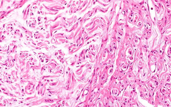 4A3 Neuroma (Case 4) H&E 40X