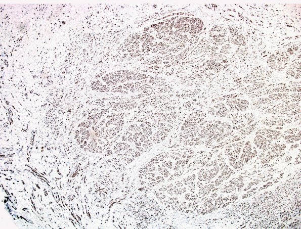 4B1 Neuroma (Case 4) NF 10X 1