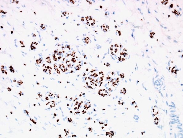 4B2 Neuroma (Case 4) NF 1.jpg