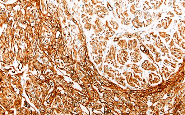 4C2 Neuroma, traumatic (Case 4) Coll IV 20X