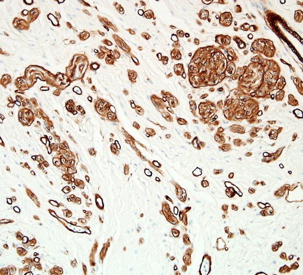 4C3 Neuroma (Case 4) Coll IV 2.jpg