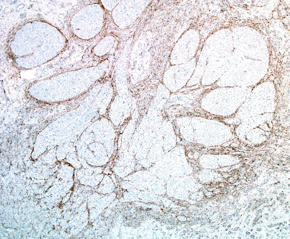 4D1 Neuroma (Case 4) EMA 4X