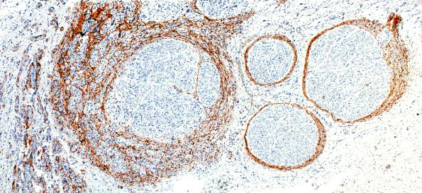 4D3 Neuroma, traumatic (Case 4) EMA 4X