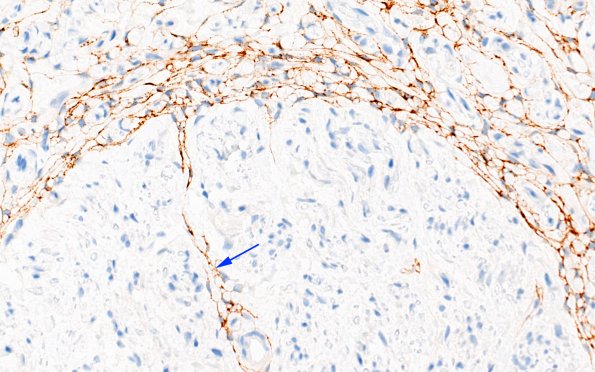 4D5 Neuroma (Case 4) EMA 40X AREA copy