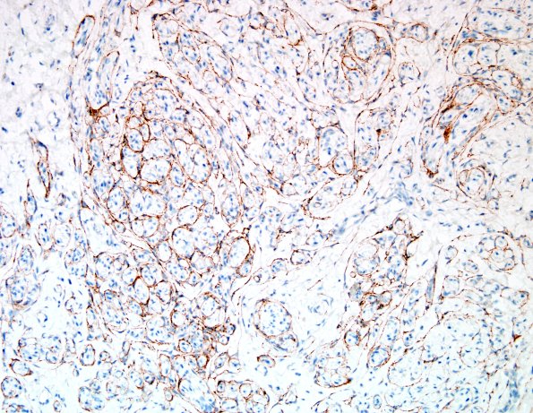4D6 Neuroma (Case 4) EMA 6.jpg