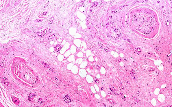 5A2 Morton neuroma (Case 5) H&E 10X 1