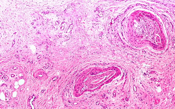 5A3 Morton neuroma (Case 5) H&E 10X 2