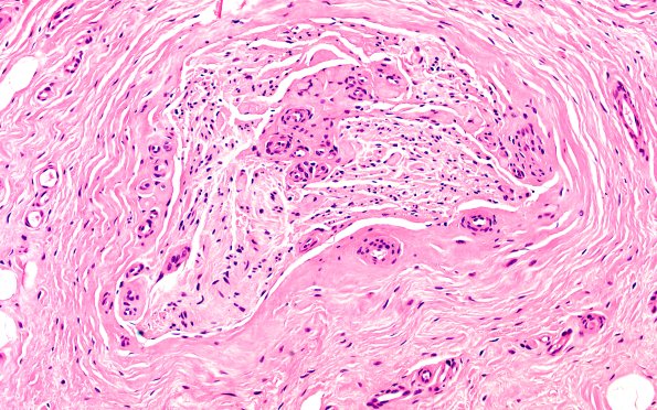 5A4 Morton neuroma (Case 5) H&E 20X 1