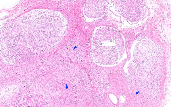 6A1 Neuroma (Case 6) PROX H&E 4X 1 copy
