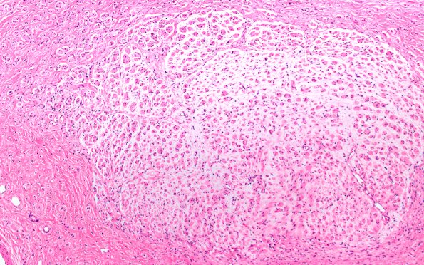 6A2 Neuroma (Case 6) PROX H&E 10X 1