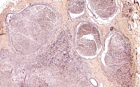 6B1 Neuroma (Case 6) PROX NF 4X 1