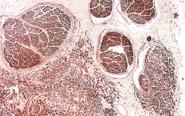 6C1 Neuroma (Case 6) PROX S100 4X 1AA