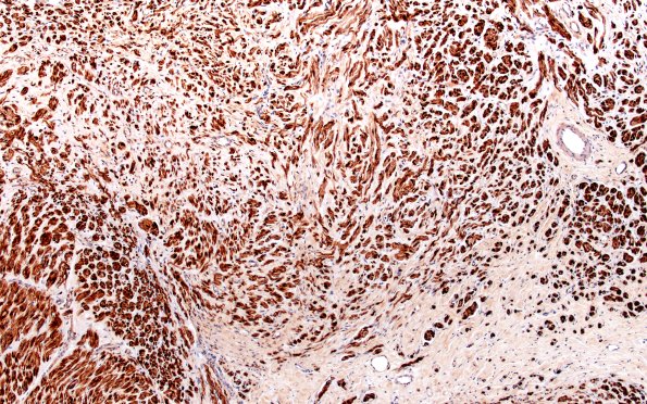 6C2 Neuroma (Case 6) PROX S100 10X 1