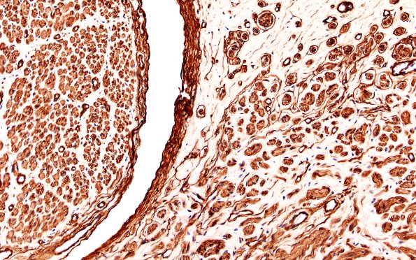 6D Neuroma (Case 6) PROX Coll IV 20X 1