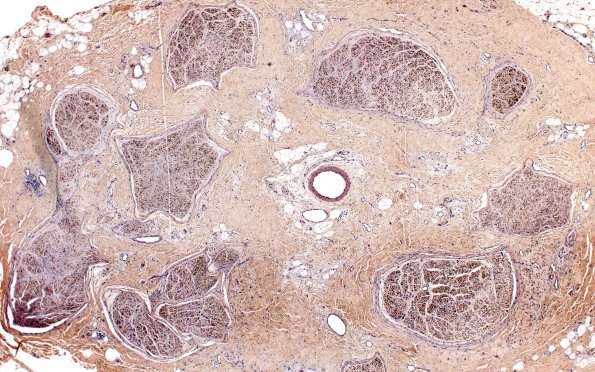 6F1 Neuroma (Case 6) DISTAL NF 4X 1