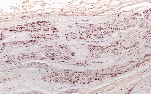 6F2 Neuroma (Case 6) DISTAL NF 10X 1