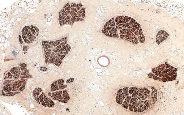 6G Neuroma (Case 6) DISTAL S100 4X 1