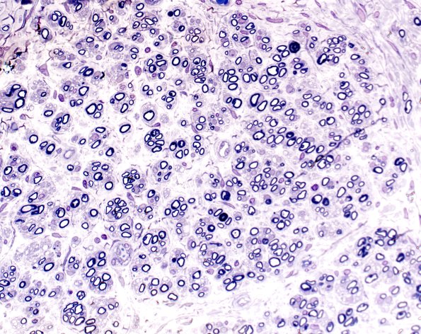 6H1 Neuroma (Case 6) 20X 2