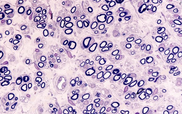 6H2 Neuroma (Case 6) 100X 2
