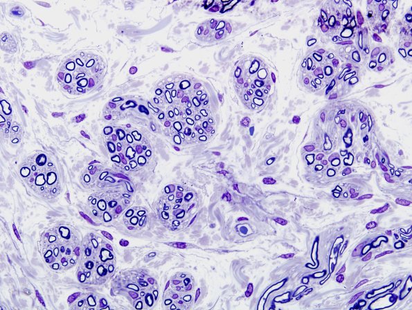 6H3 Neuroma, traumatic (Case 6) Plastic 2