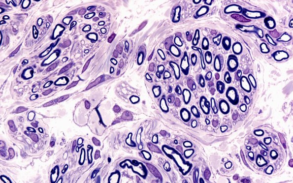 6H4 Neuroma (Case 6) 100X 3