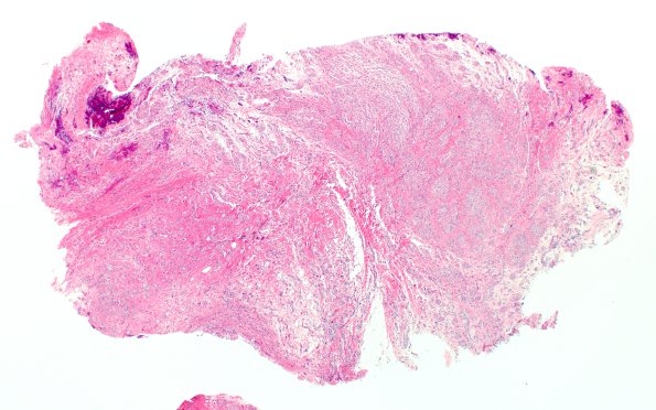 7A1 Neuroma, brachial (Case 7) H&E 2X