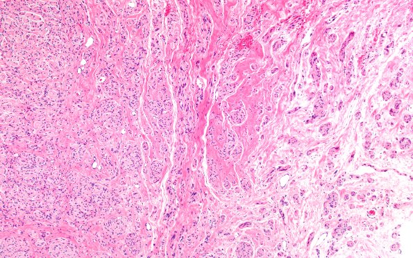 7A2 Neuroma, brachial (Case 7) H&E 10X