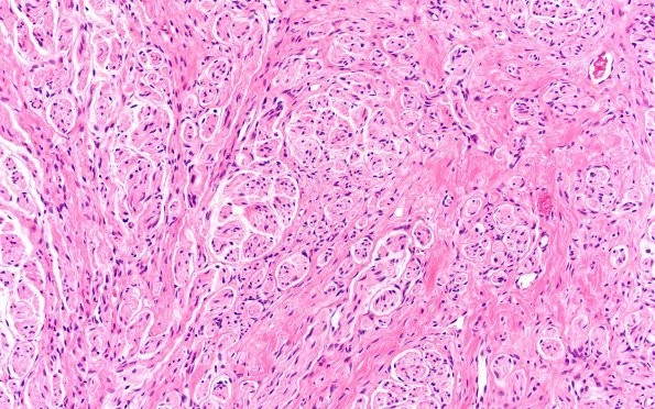 7A3 Neuroma, brachial (Case 7) H&E 20X
