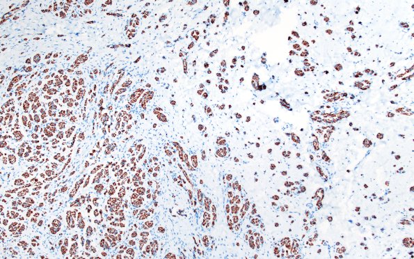 7B2 Neuroma, brachial (Case 7) NF 10X