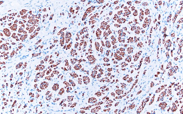 7B3 Neuroma, brachial (Case 7) NF 20X