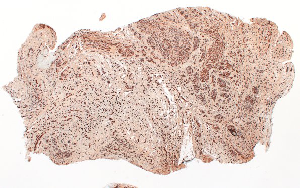 7C1 Neuroma, brachial (Case 7) S100 2X