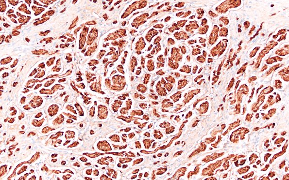 7C3 Neuroma, brachial (Case 7) S100 20X