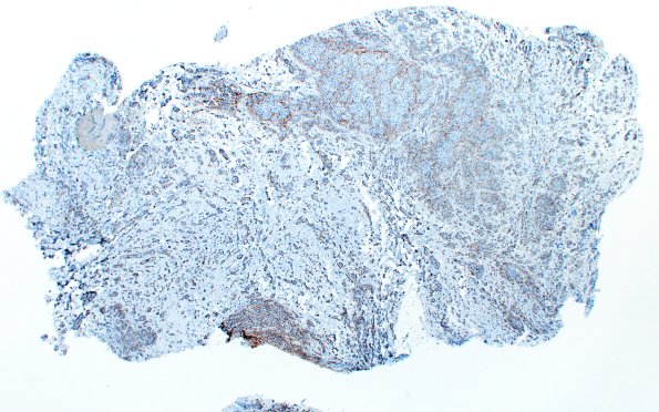 7D1 Neuroma, brachial (Case 7) EMA 2X