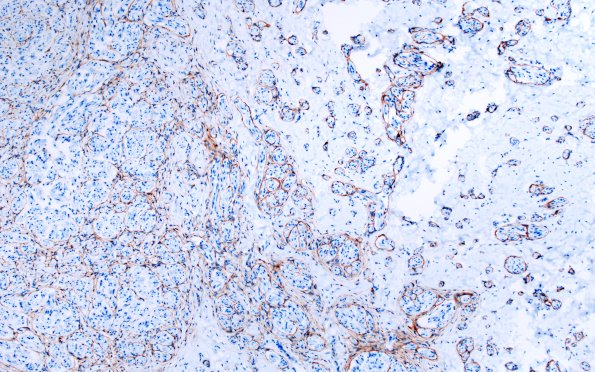 7D2 Neuroma, brachial (Case 7) EMA 10X