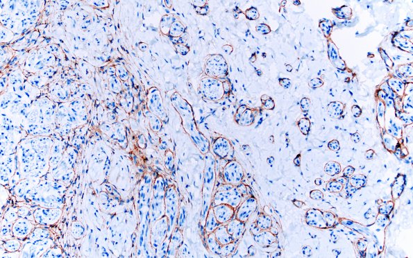 7D3 Neuroma, brachial (Case 7) EMA 20X