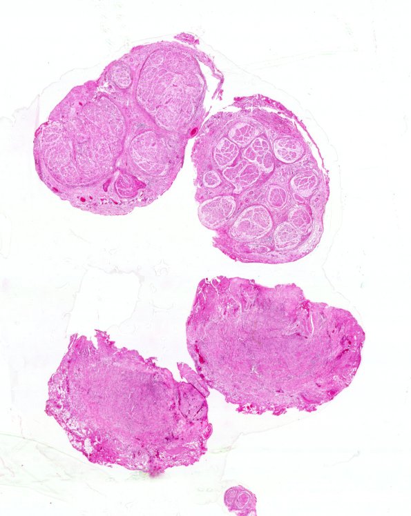 8A1 Neuroma, traumatic (Case 8) H&E WM