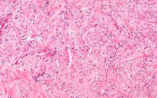 8A2 Neuroma, traumatic (Case 8) H&E 20X