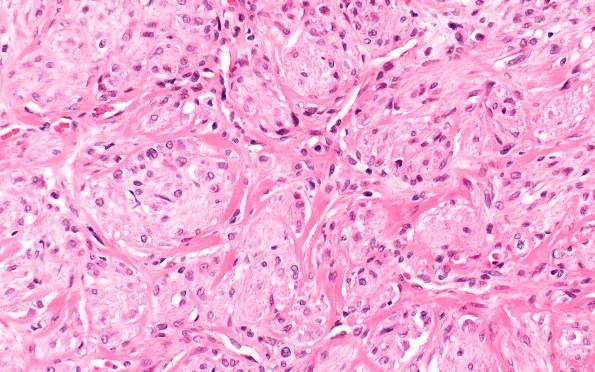 8A3 Neuroma, traumatic (Case 8) H&E 40X