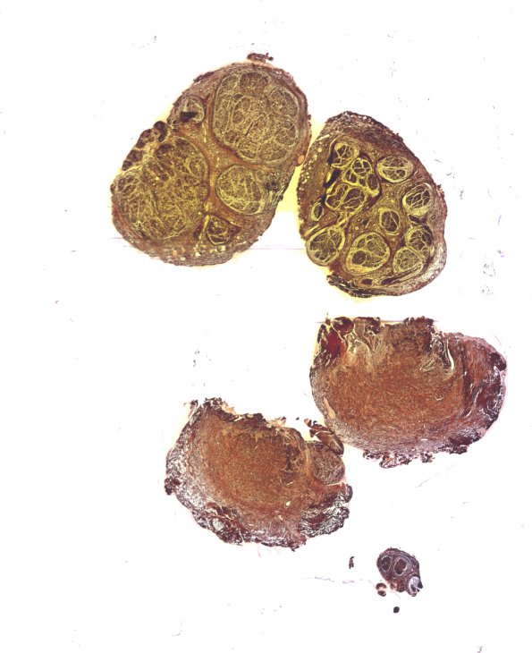 8B1 Neuroma, traumatic (Case 8) Sevier-Munger WM