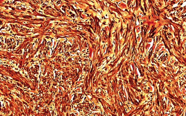 8B2 Neuroma, traumatic (Case 8) Sevier-Munger 20X