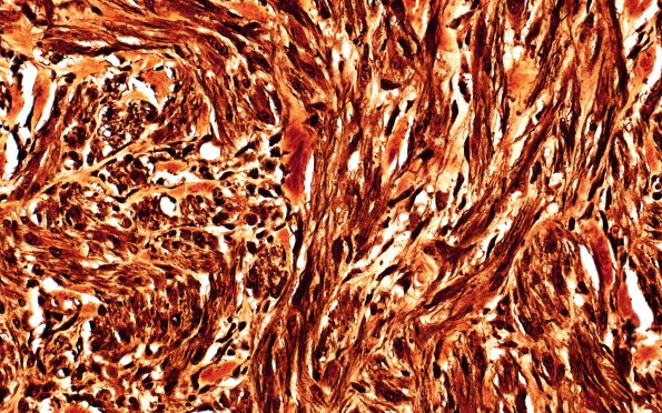 8B3 Neuroma, traumatic (Case 8) Sevier-Munger 40X